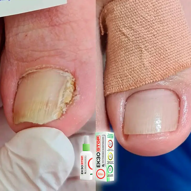 ЕкзоStop відгук 1