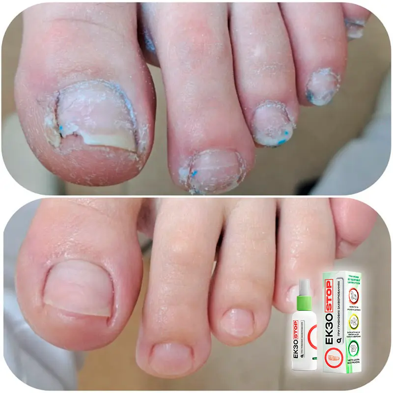 ЕкзоStop відгук 2