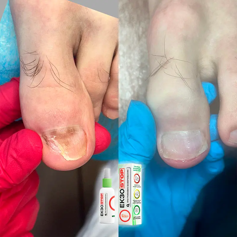 ЕкзоStop відгук 3