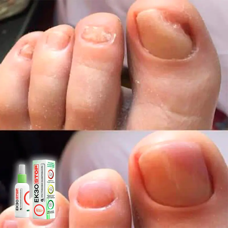 ЕкзоStop відгук 5